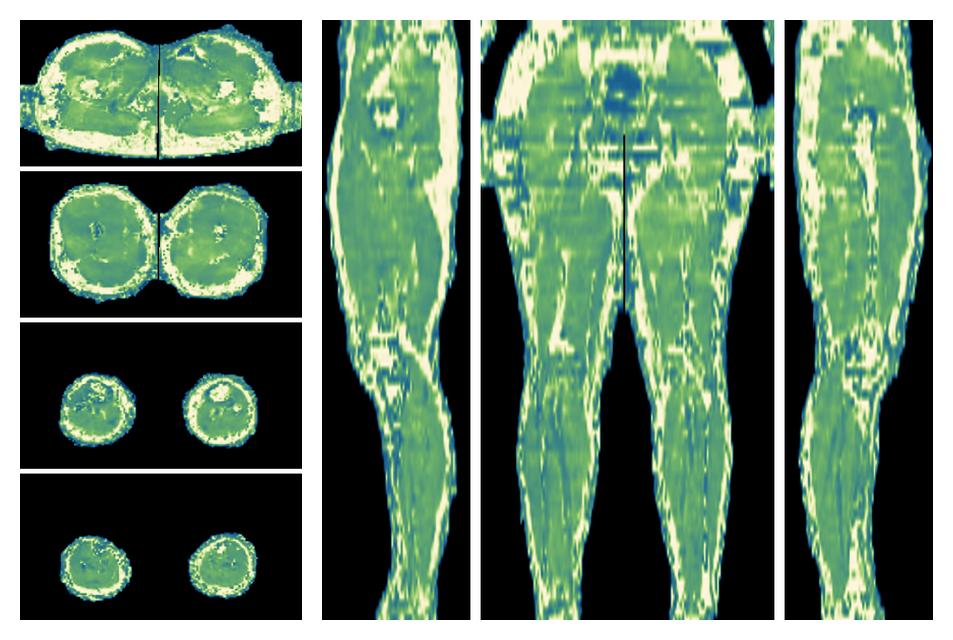 The water only T2 relaxation time of the lower extremity obtained from multi echo spin echo t2 mapping with EPG based reconstruction.